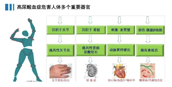 BISPIT全新升级控酸方案|止痛是治标，溶解结晶是治本